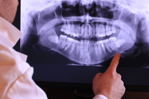 Best Emergency Dentist for Lost Fillings or Crowns in Port Angeles East, WA